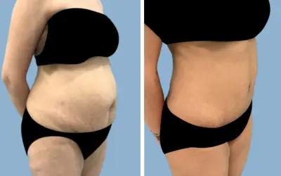 Before and After